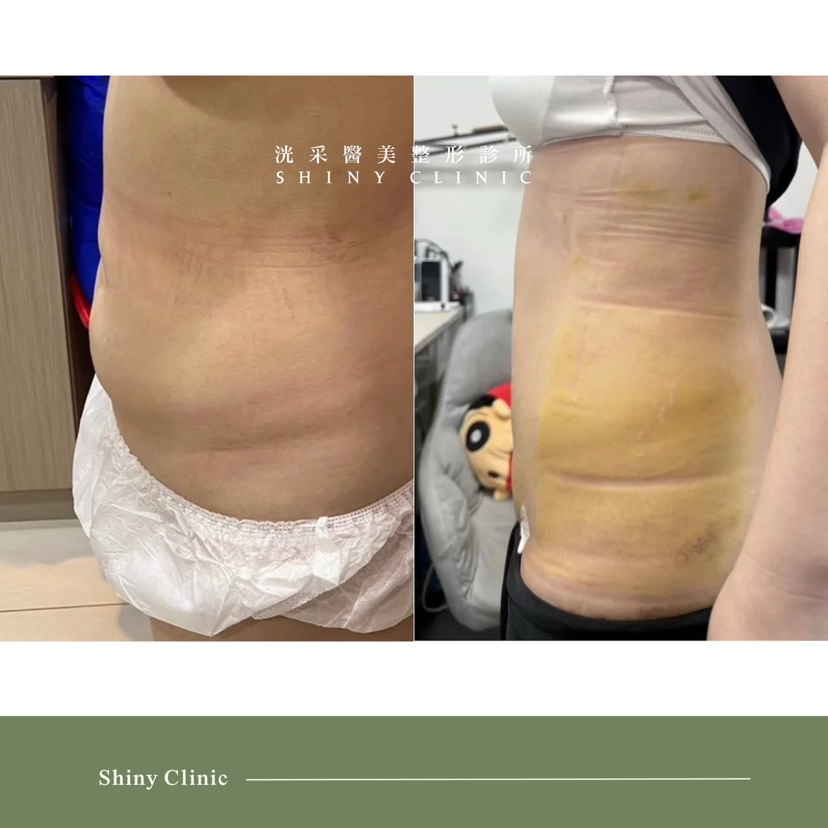 抽脂手術案例 1